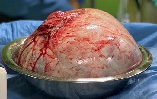 KS Hegde-ovarian cyst